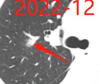 干咳两个月查出肺癌,物流专线直达_123随叫随到