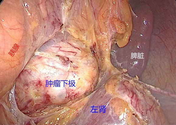 腹腔长40厘米长肿瘤,快递单号查询_123随叫随到